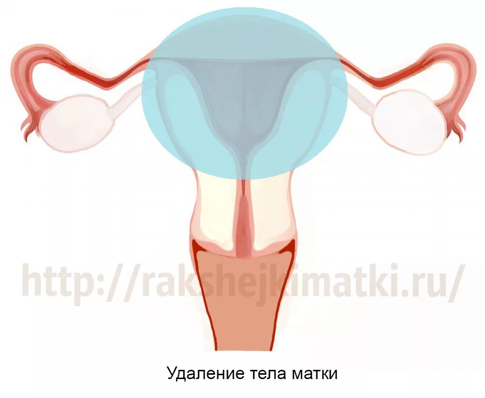 Ампутация и экстирпация матки.