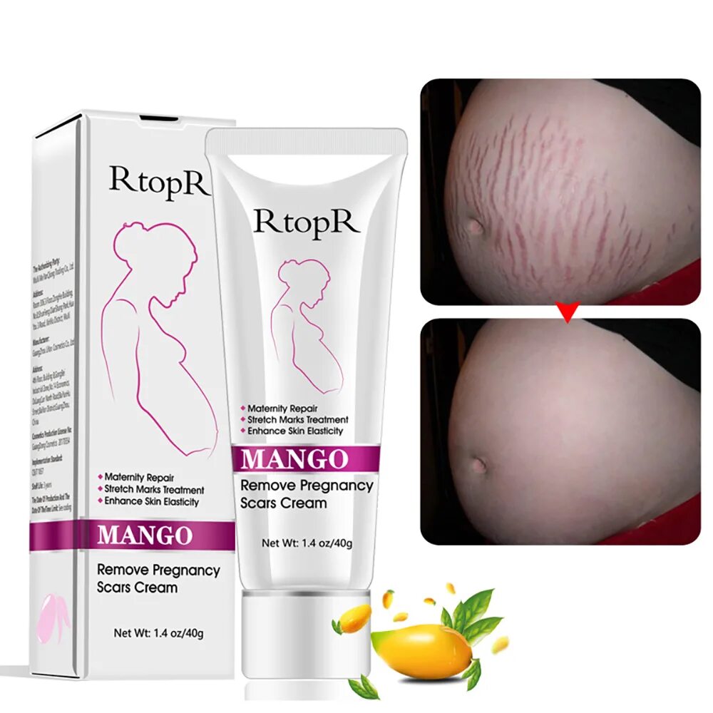 Беременность от растяжек лучше. Stretch marks cream от растяжек. rtopr mango крем. крем растяжки китай stretch marks. anti stretch mark cream для беременных.