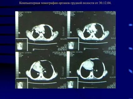 Повреждения органов грудной полости