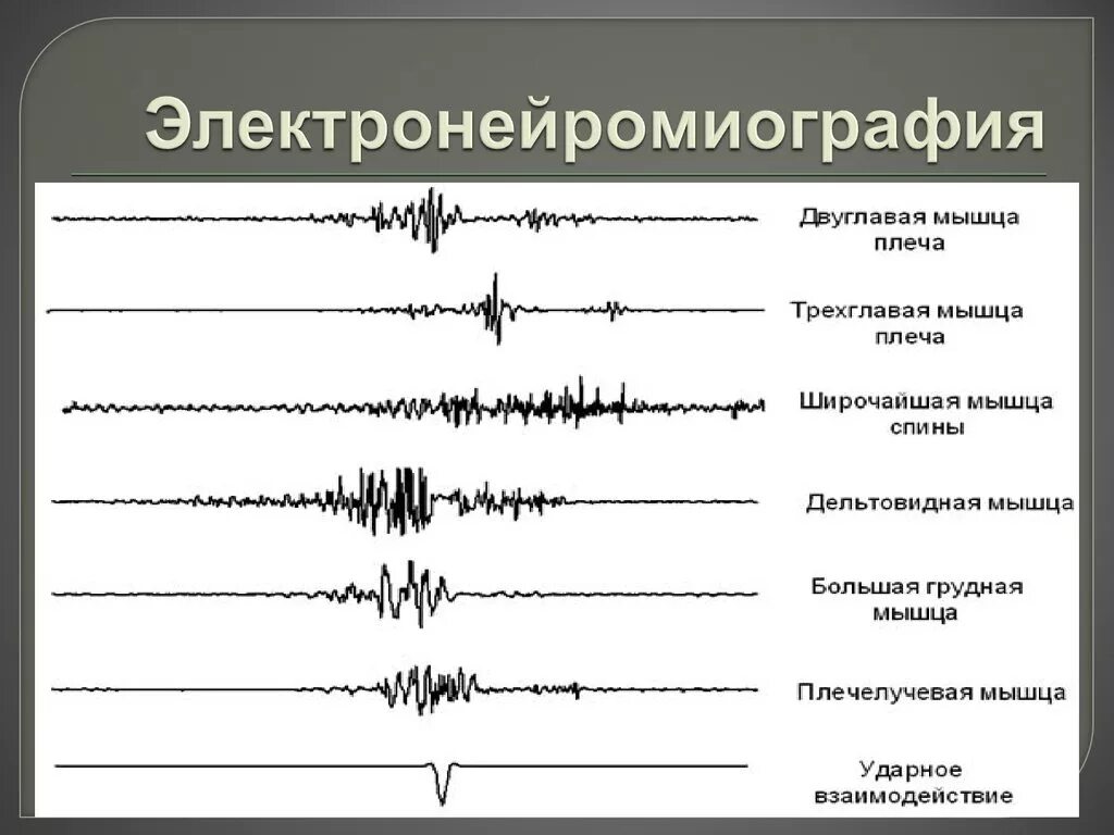 Эмг сайт. Эмг исследования нормы. игольчатая электромиография схема. электромиография расшифровка результатов. электромиография расшифровка электромиограммы.