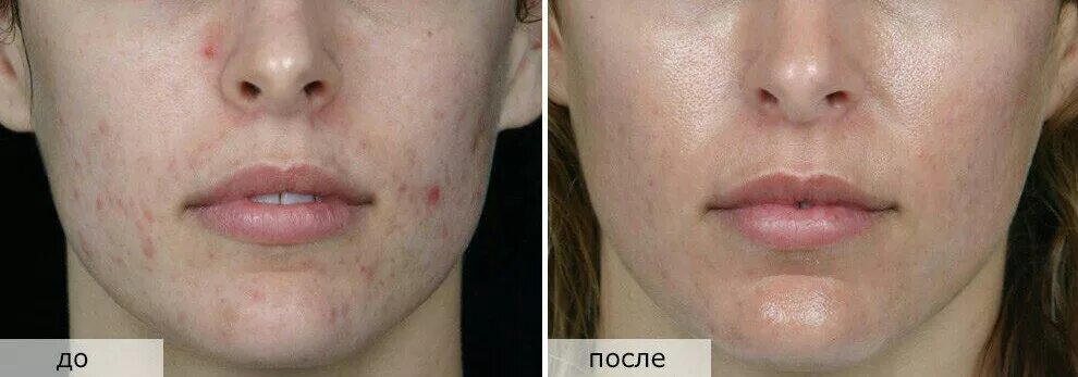 Ультразвуковая чистка лица до и после. Чистка лица до и после фото. Ультразвуковая очистка лица до и после. Лицо до и после косметолога.