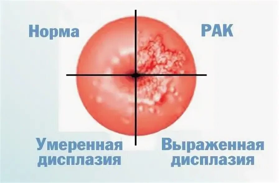 Умеренная дисплазия шейки матки что это. Дисплазия шейки матки кольпоскопия. Классификация дисплазии эпителия шейки матки. Стадии дисплазии шейки матки.