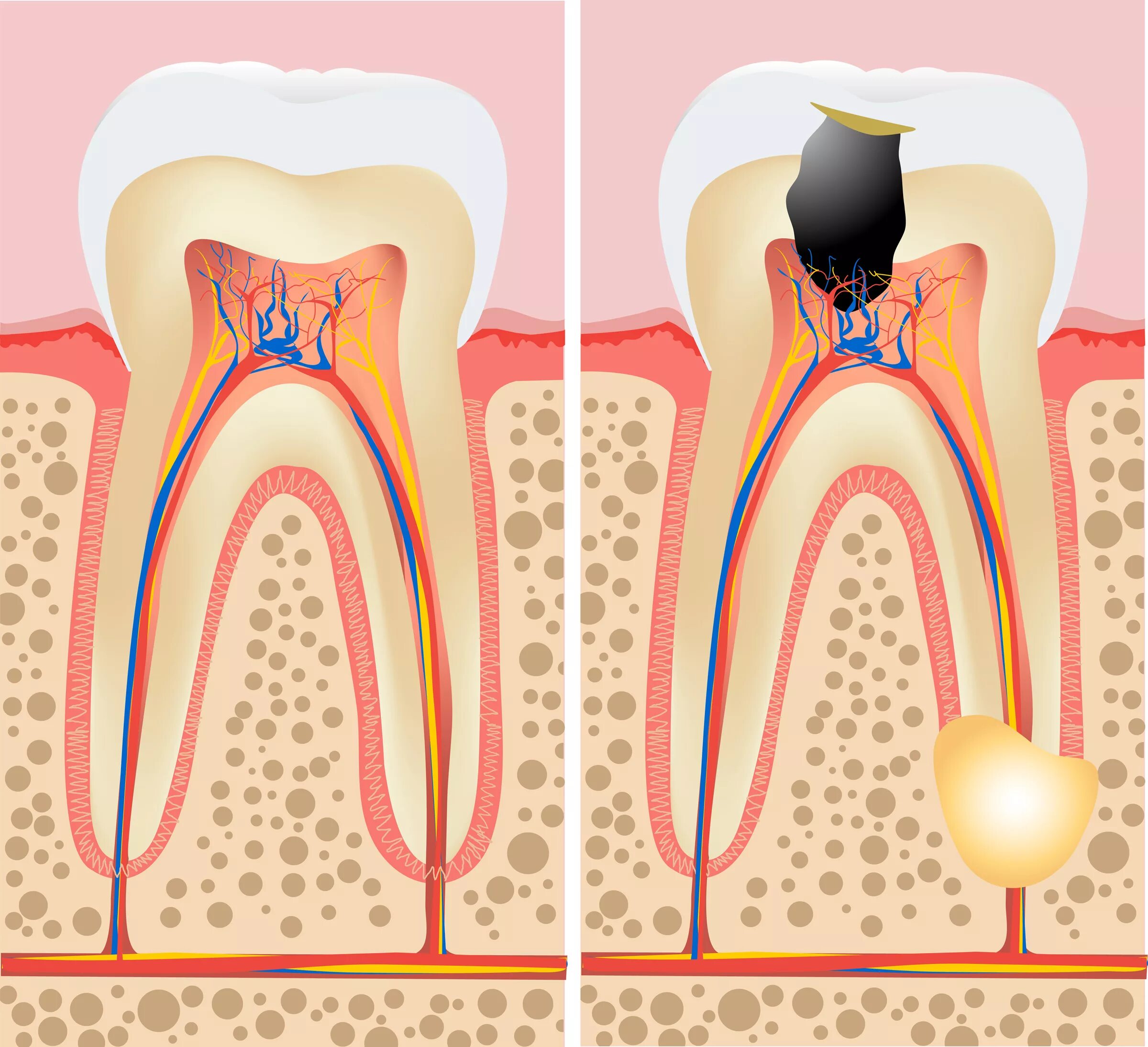 Root canal. Периодонтит гранулема.