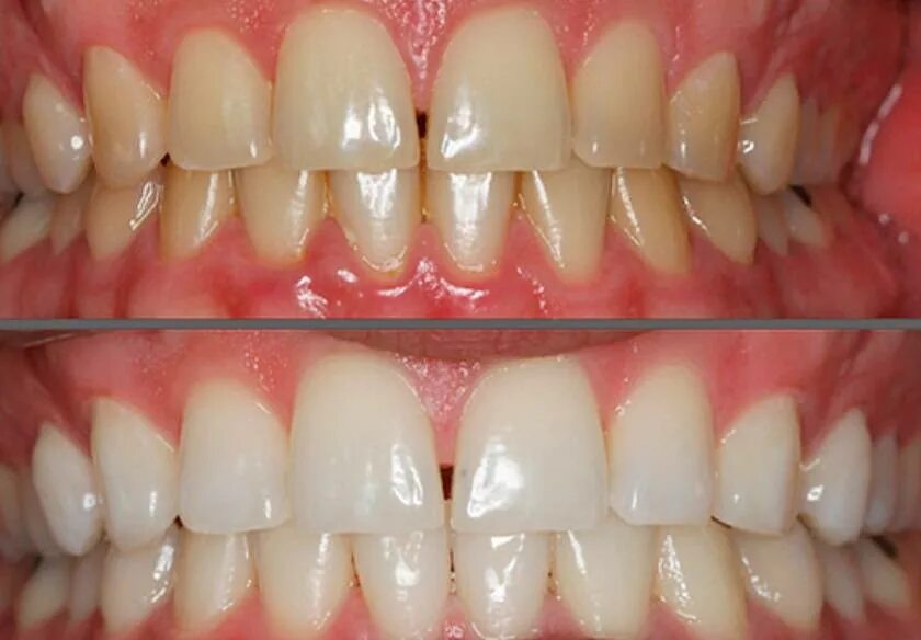 Лазерное отбеливание Opalescence Boost. Деминерализация зубов до и после. Гигиена зубов до и после. Деминерализация эмали. Чистка зубов после лечения