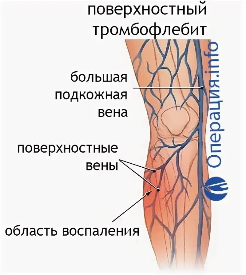 Классификация тромбофлебита поверхностных вен нижних конечностей. Тромбофлебит глубоких вен нижних конечностей. Тромбофлебит поверхностных вен голени. Острый тромбофлебит поверхностных вен. Тромбоз подвздошной вены