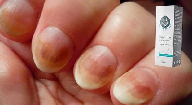 Онихолизис капли отзывы. Лекарство от онихолизиса ногтей. Мазь онихолизис ногтей. Препараты при онихолизисе ногтей на руках.