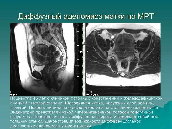 Признаки диффузной матки. Диффузный аденомиоз матки мрт. Диффузная форма аденомиоза мрт.