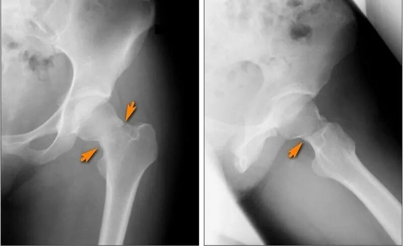 Трещина тазобедренного. Вколоченный перелом шейки бедра рентген. Аддукционный перелом шейки бедра рентген. Субкапитальный перелом шейки бедра рентген. Перелом шейки бедренной кости рентген.