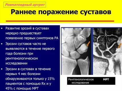 Симптомы ревматоидного артрита