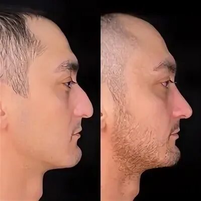 Ринопластика носа мужчины. Ринопластика до и после мужчины. Красивый мужской нос. Ринопластика носа мужчины. Ринопластика.