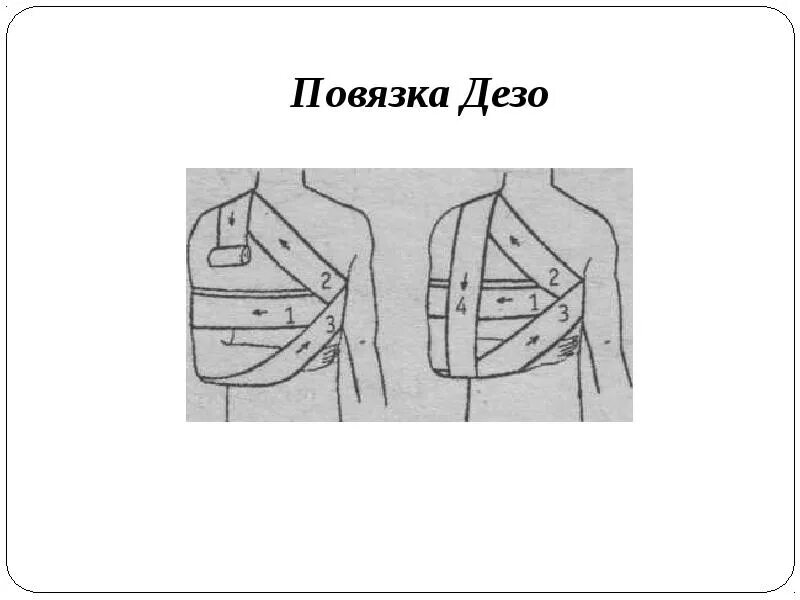 Плечевая повязка алгоритм. Технику наложения повязки Дезо.. Повязка Дезо техника наложения. Схема наложения повязки Дезо. Десмургия повязка Дезо.