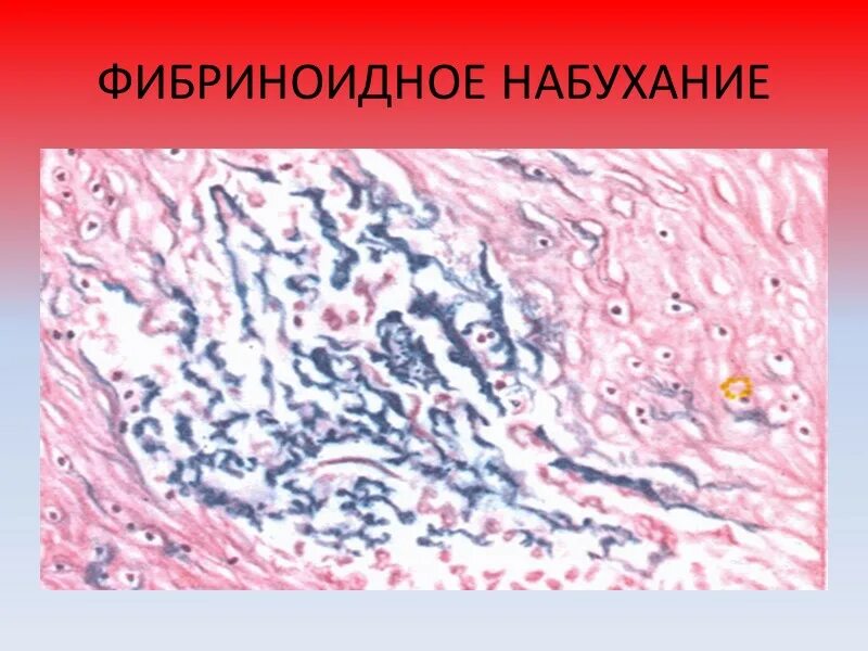 Мезенхимальные белковые. Фибриноидное набухание соединительной ткани препарат. Фибриноидное набухание соединительной ткани микропрепарат. Фибриноидное набухание гистология. Мукоидное набухание фибриноидное набухание гиалиноз.