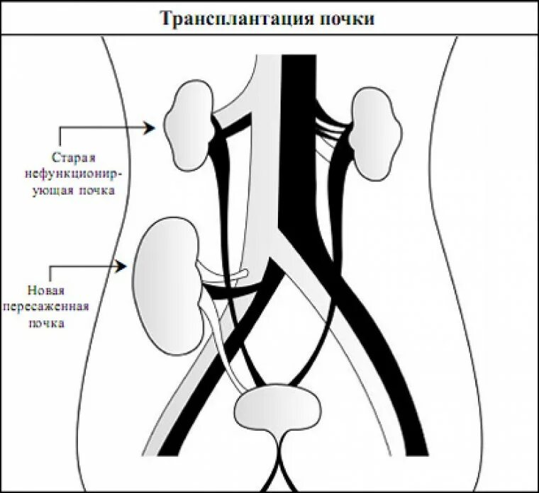 Почему подсаживают. Схема операций трансплантации почки. Донорский этап трансплантации почки. Трансплантация почки этапы операции. Этапы трансплантации почки хирургия.