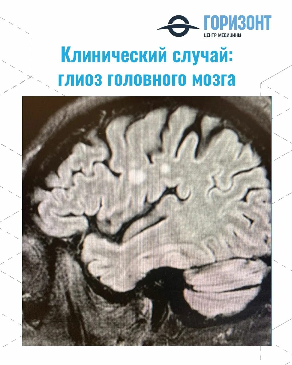 Глиоз мозжечка мрт. Кортикальный глиоз. Глиоз головного мозга кт. Глиоз на мрт.