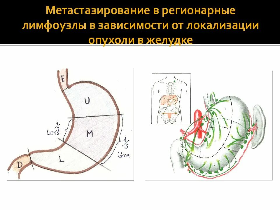 Метастазированные лимфоузлы. Регионарные лимфатические узлы схема. Регионарные лимфатические узлы желудка. Метастазирование в лимфоузлы. Метастазирование в регионарные лимфоузлы.