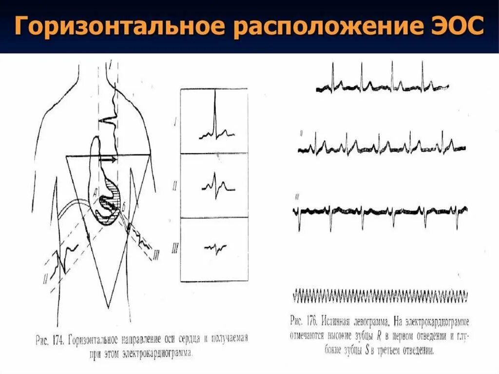 Положение электрической оси сердца горизонтальное что значит. Горизонтальное расположение эос на экг. горизонтальному положению электрической оси сердца соответствует. горизонтальное положение эос на экг. экг положение электрической оси полугоризонтальное.