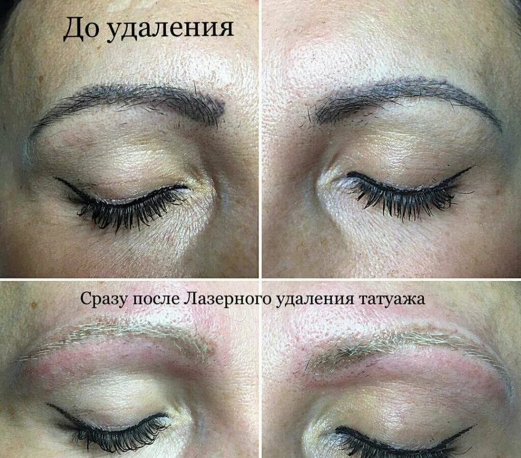 Удаление татуажа лазером в р-не Свиблово - рядом 12 мастеров татуажа, 10 отзывов
