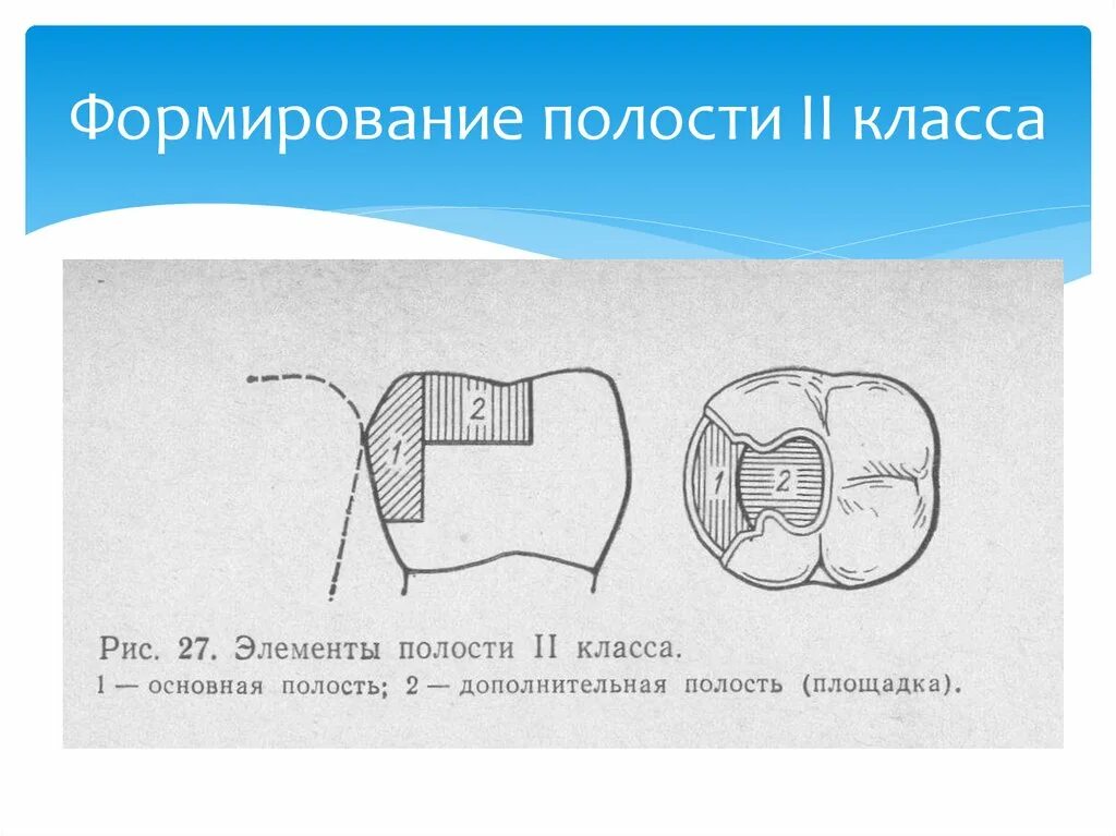 Препарирование зуба по блэку. Препарирование кариозных полостей 2 класса по блэку. препарирование кариозных полостей 2 класса. препарирование кариозных полостей 1 класса по блэку.