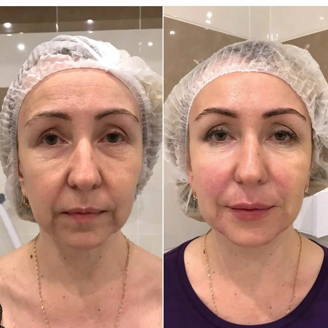 векторный лифтинг до и после. армирование мезонитями. биоармирование лица фото до и после. векторный лифтинг википедия. векторный лифтинг гиалуроновой кислотой.