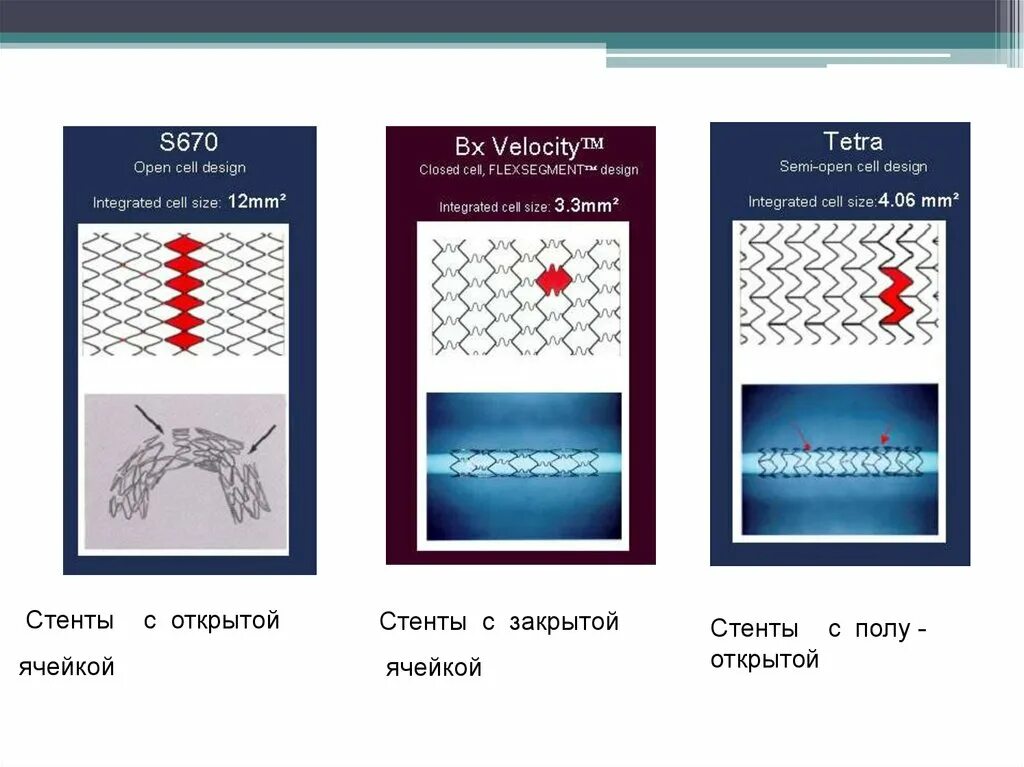 Стент виды. Типы стентов. Стент открытый закрытый. Стент с открытой ячейкой. Поколения стентов.