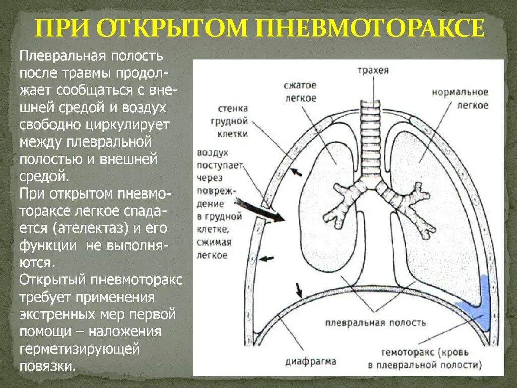 Плевральные синусы схема. Плевральные синусы анатомия. Плевральная полость пневмоторакс. Плевра и плевральная полость.