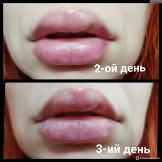 Через сколько пройдет отек