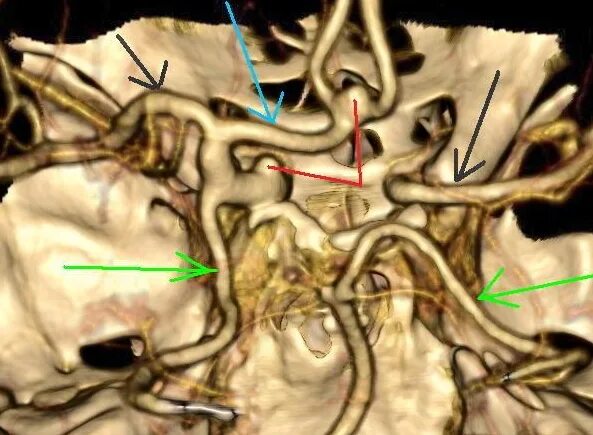 Трифуркация правой внутренней сонной. Аплазия позвоночной артерии.