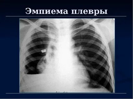 Пиоторакс с фистулой