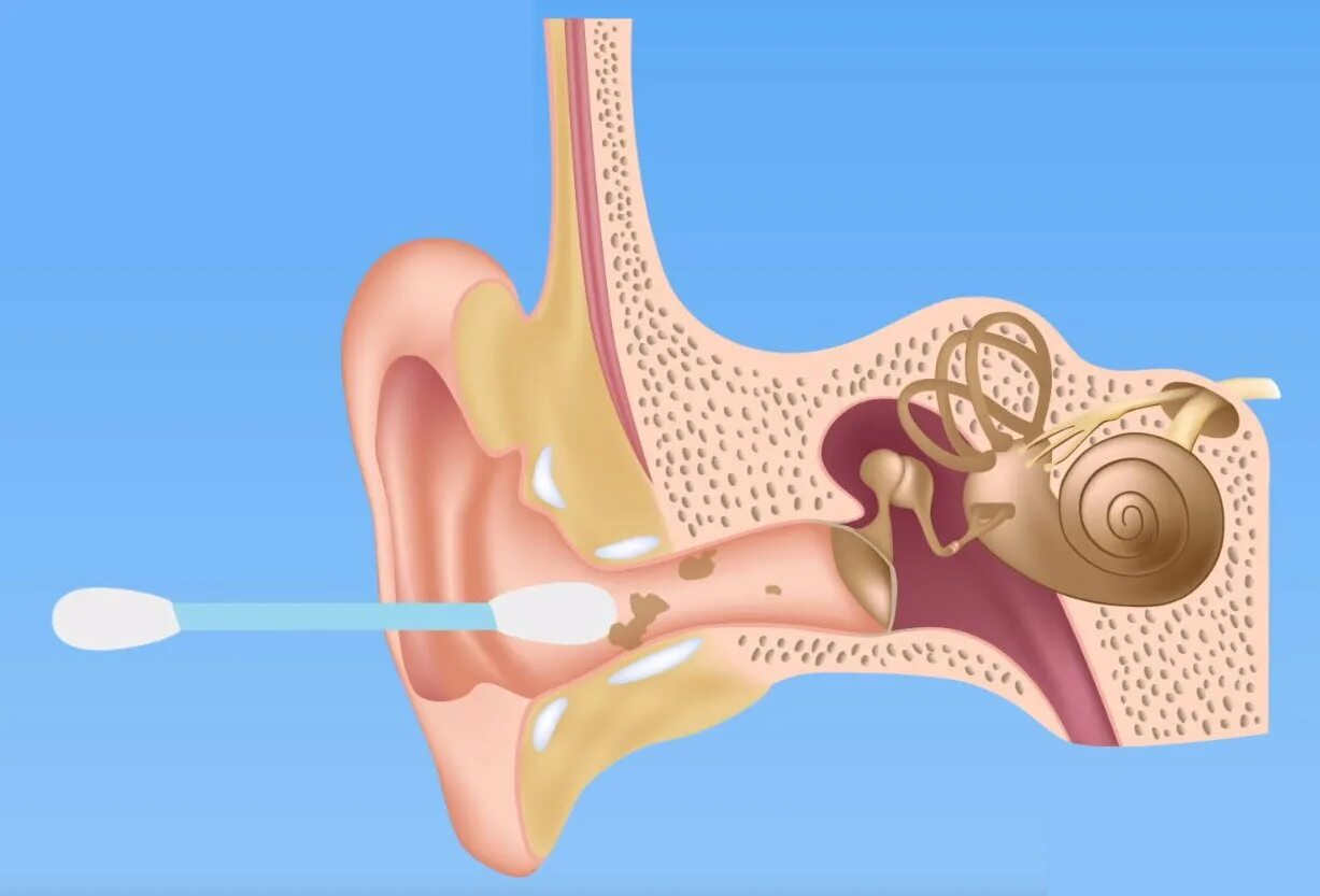 Шум в ушах после отита. Ушная барабанная перепонка. Перфорация барабанной перепонки. Барабанная перепонка отит.