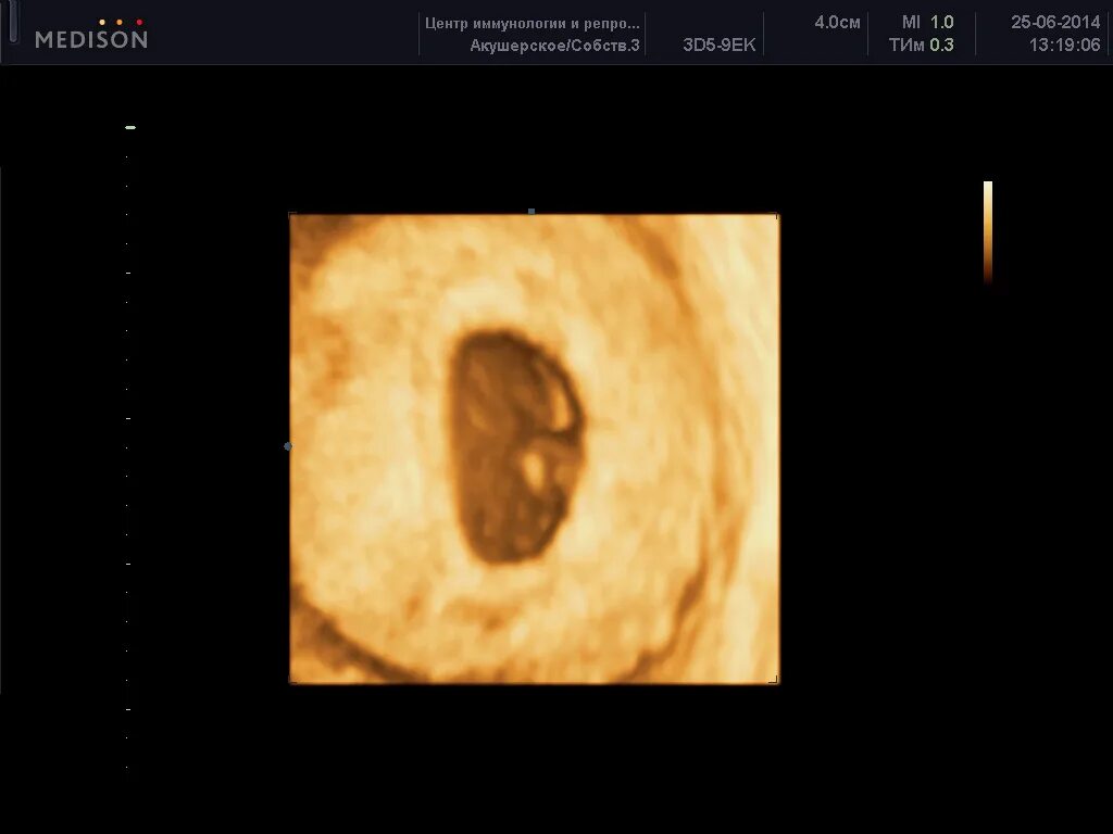 3д УЗИ на 6 неделе беременности. Фото эмбриона на 6 неделе беременности на УЗИ. УЗИ 3d 6 недель беременности. 7 Недель беременности 3д УЗИ. Курс 6 недель