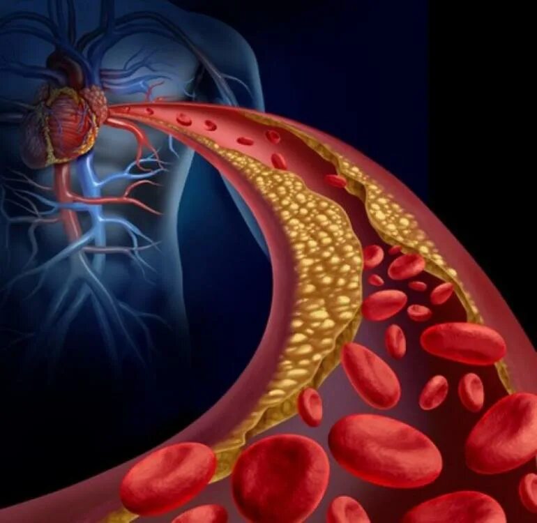 Болезни кровеносного сосуда. Гиперхолестеринемия дислипидемия. Холестериновые бляшки в сосудах.