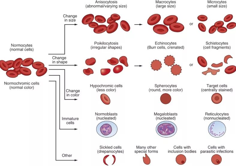 Пониженные макроциты. Анизоцитоз эритроцитов. Анизоцитоза эритроцитов. Анизоцитоз и пойкилоцитоз. Клетки патологической регенерации эритроцитов.