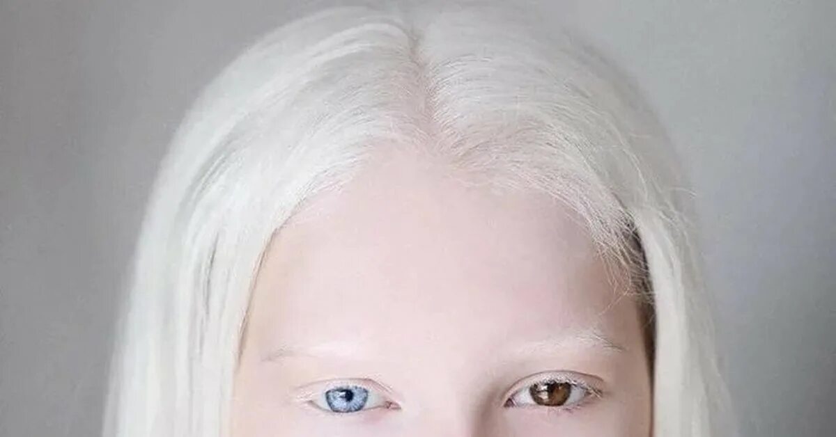 Глазно-кожный альбинизм. Глазокожный альбинизм 4 типа. Глазокожный альбинизм Тип 2. Альбинизмом страдают