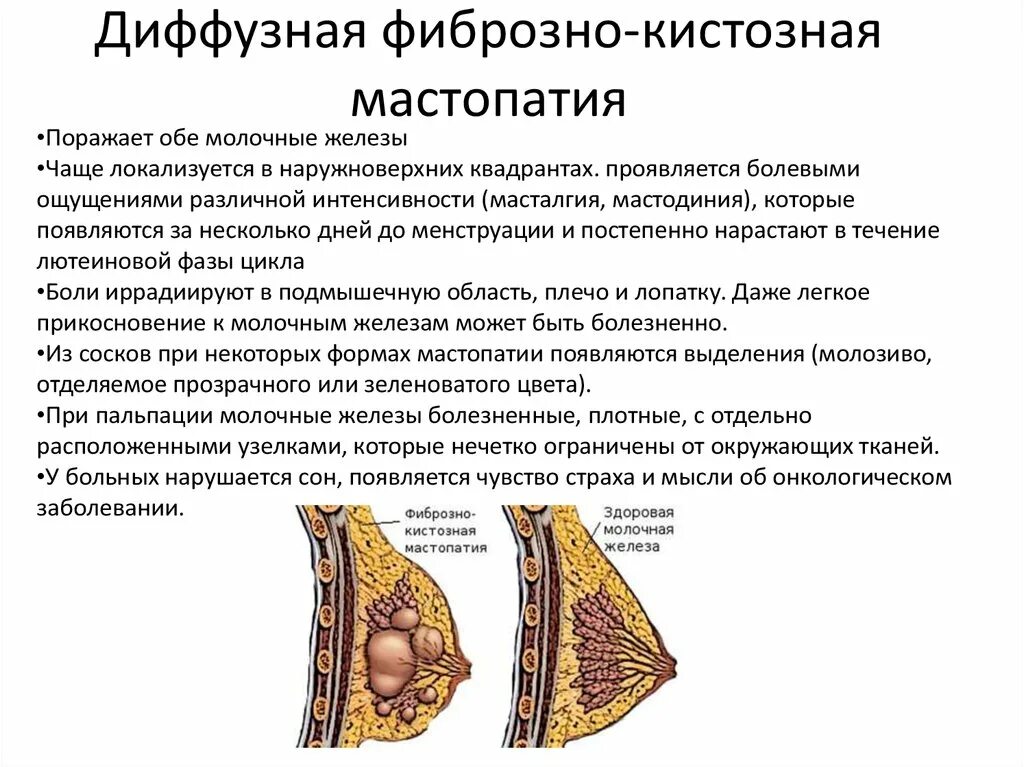 Фиброзно-кистозная мастопатия симпто. Диффузно-фиброзная мастопатия молочной железы. Диффузная кистозная мастопатия. Фиброзно-кистозная мастопатия молочных желез симптомы.