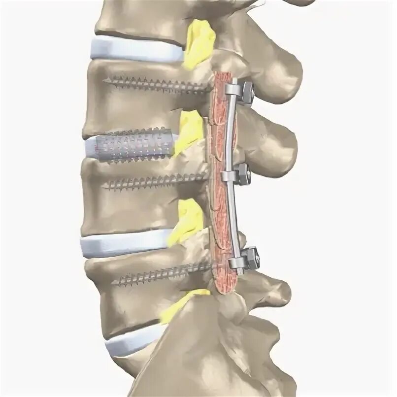 Межтеловой спондилодез Кейджем. Fusion - спондилодез. Кейдж для позвоночника поясничного отдела.