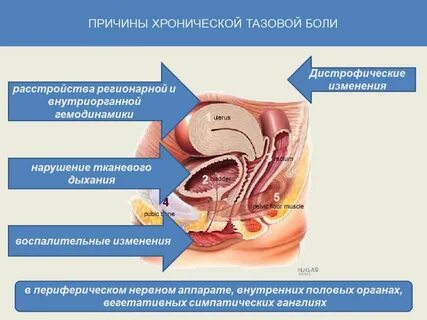 Тазовая невралгия у женщин