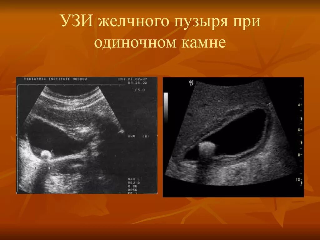 Сонограмма желчного пузыря. Конкремент в шейке желчного пузыря на узи. Диаметром 15 миллиметров камень в желчном пузыре. Камни в желчном пузыре узи. Узи видно камни желчном пузыре.