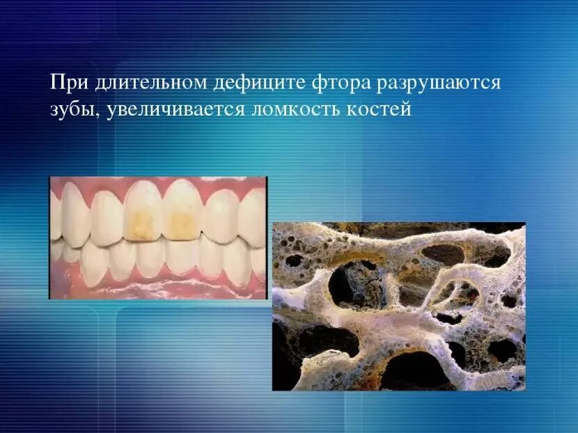 Фтор признаки. Заболевания связанные с недостатком фтора. Избыток фтора в организме человека. Нехватка фтора в организме. Разрушение зубов и костей.