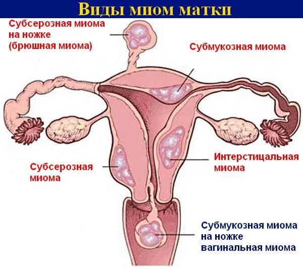 Сильная боль в матке. Менструация при миоме матки. Субсерозная миома матки.