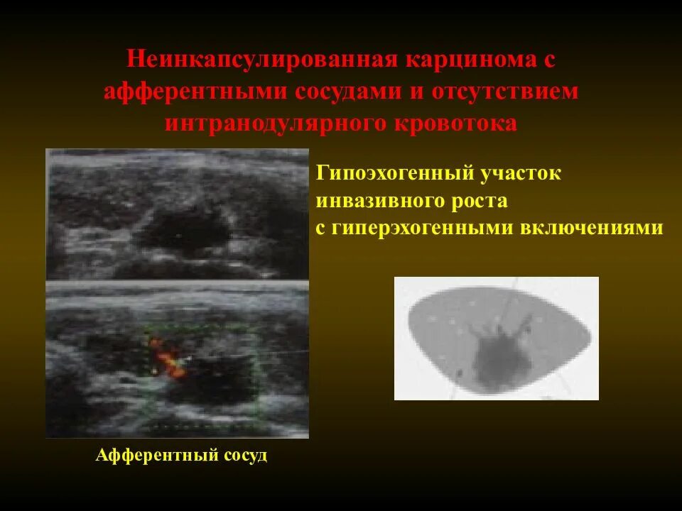 Гиперэхогенным округлым образованием. Анэхогенный узел щитовидной железы. Изоэхогенный узел щитовидной железы что это такое. Гипоэхогенное узловое образование в щитовидной железе. Гиперэхогенное образование щитовидной железы.