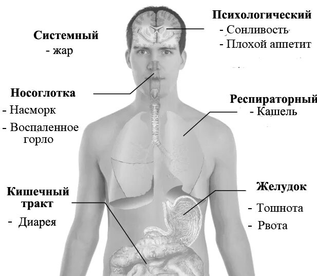 Брюшной грипп. Свиной грипп симптомы. Симптомы при Свином гриппе. Горло при Свином гриппе. Фотография человека болеющего свиным гриппом.