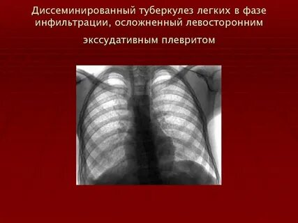 Лечение диссеминированного туберкулеза легких