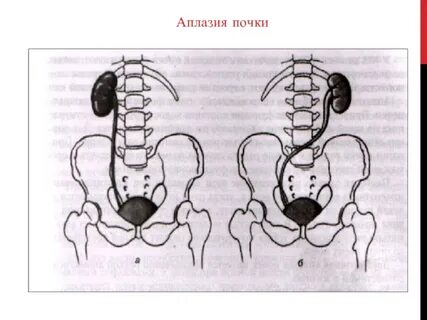 Агенезия почки