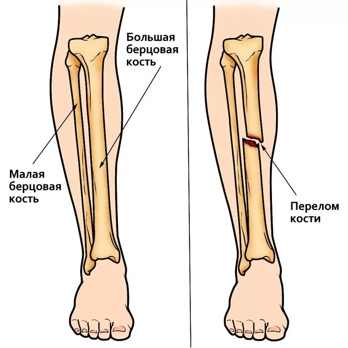 Почему болит кость после перелома. Большеберцовая кость перелом. Перелом берцовая кость кости. Закрытый перелом диафиза большеберцовой кости. Перелом малоберцовой кости.