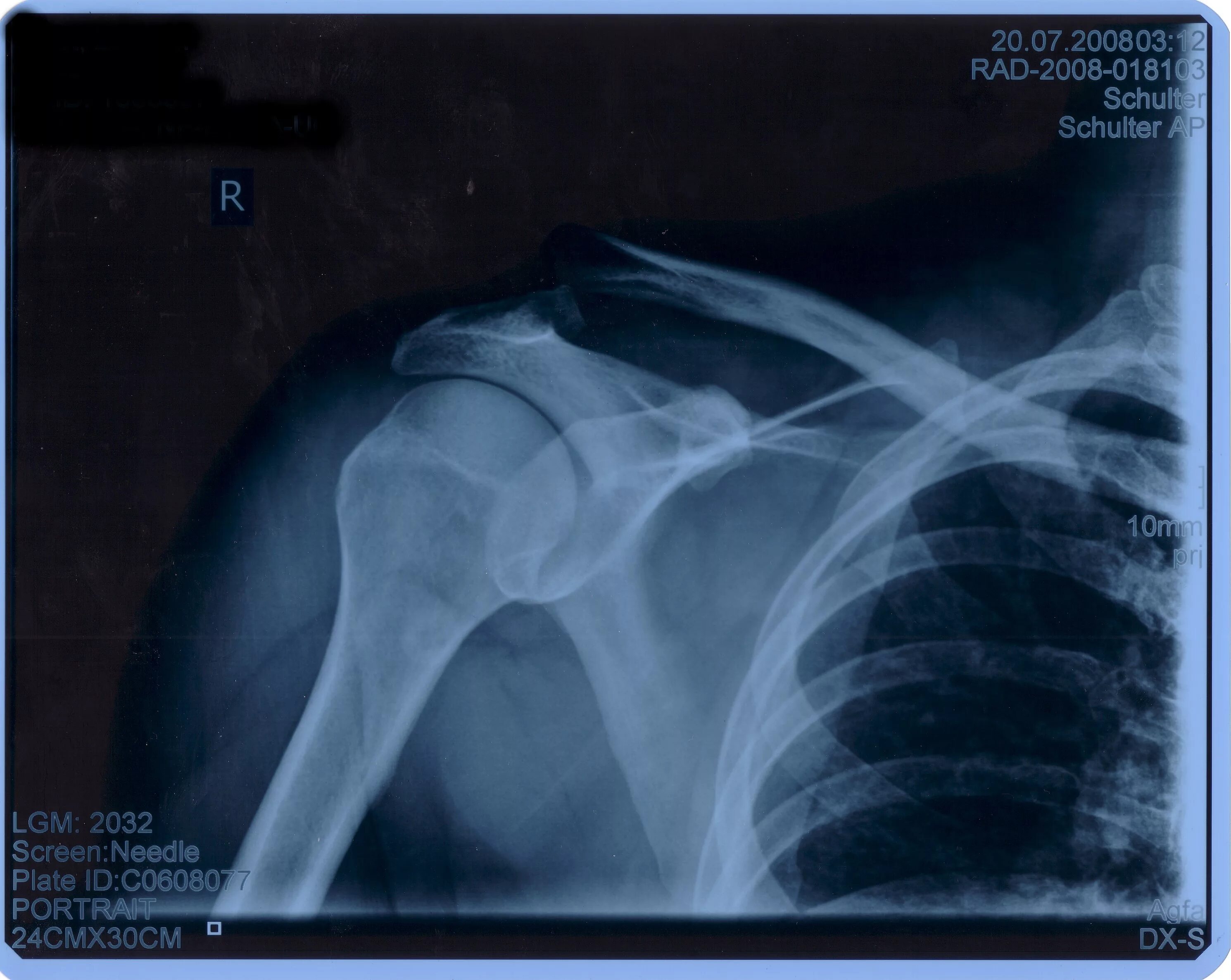 Показать разрыв. Рентген показывает разрыв связок. Снимки плеча при порванных связках.