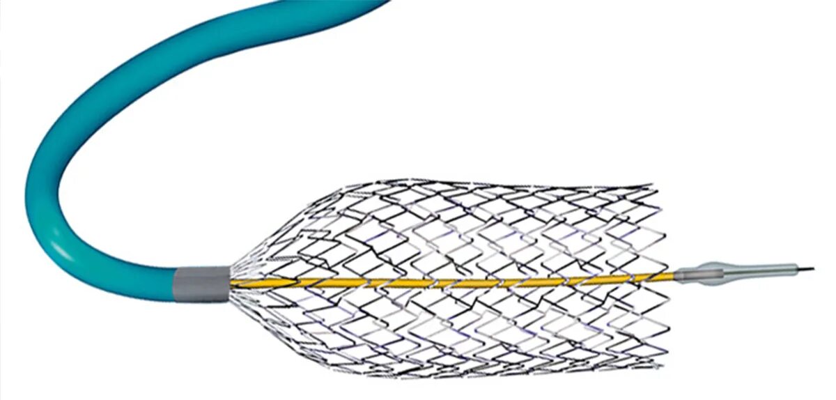 Лекарственный стент. Нитинол стент. Саморасширяющийся стент. Стент сосудистый саморасширяющийся zilver Flex 35. Стент периферический саморасширяющийся Abbot.