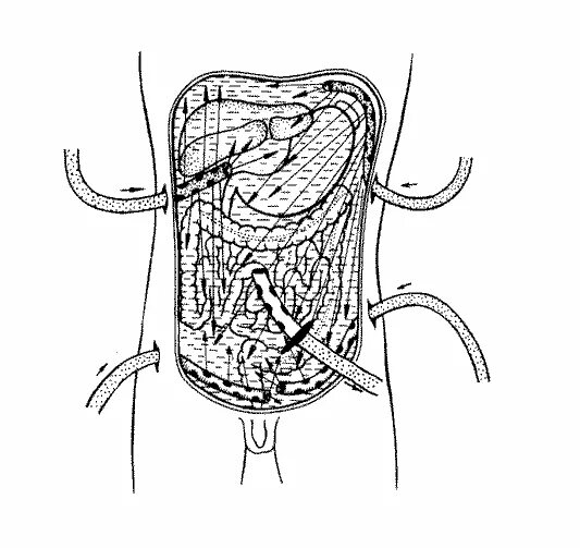 Перитонит дренирование брюшной полости. Дренирование полости абсцесса. Дренирование абсцесса брюшной полости. Активное дренирование брюшной полости. Операция по поводу перитонита