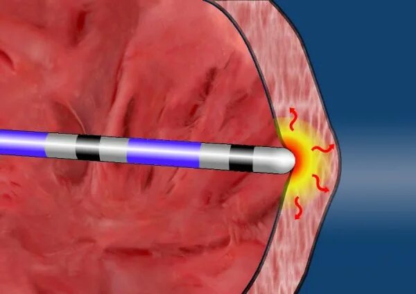 Радиочастотная катетерная абляция сердца. Катетерная абляция сердца что это такое. Операция на сердце абляция. Абляция пищевода