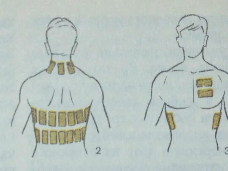 Сколько держать горчичники на спине. Горчичники при кашле. Схема наложения горчичников при кашле. Постановка горчичников при кашле. Горчичники при кашле детям.