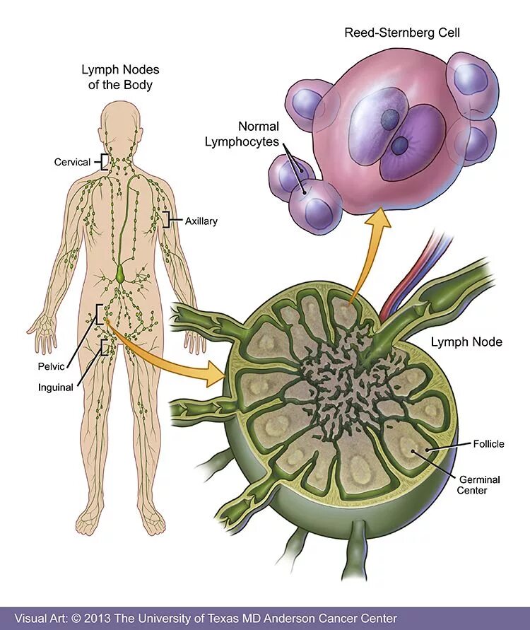 Лимфоциты в лимфатическом узле. Клетки лимфатического узла. Лимфосаркомы Ходжкина. Лимфосаркома патанатомия. Лимфоузлы цвет